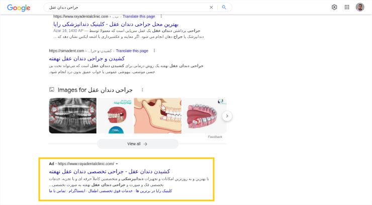 تبلیغات کشیدن دندان عقل در گوگل